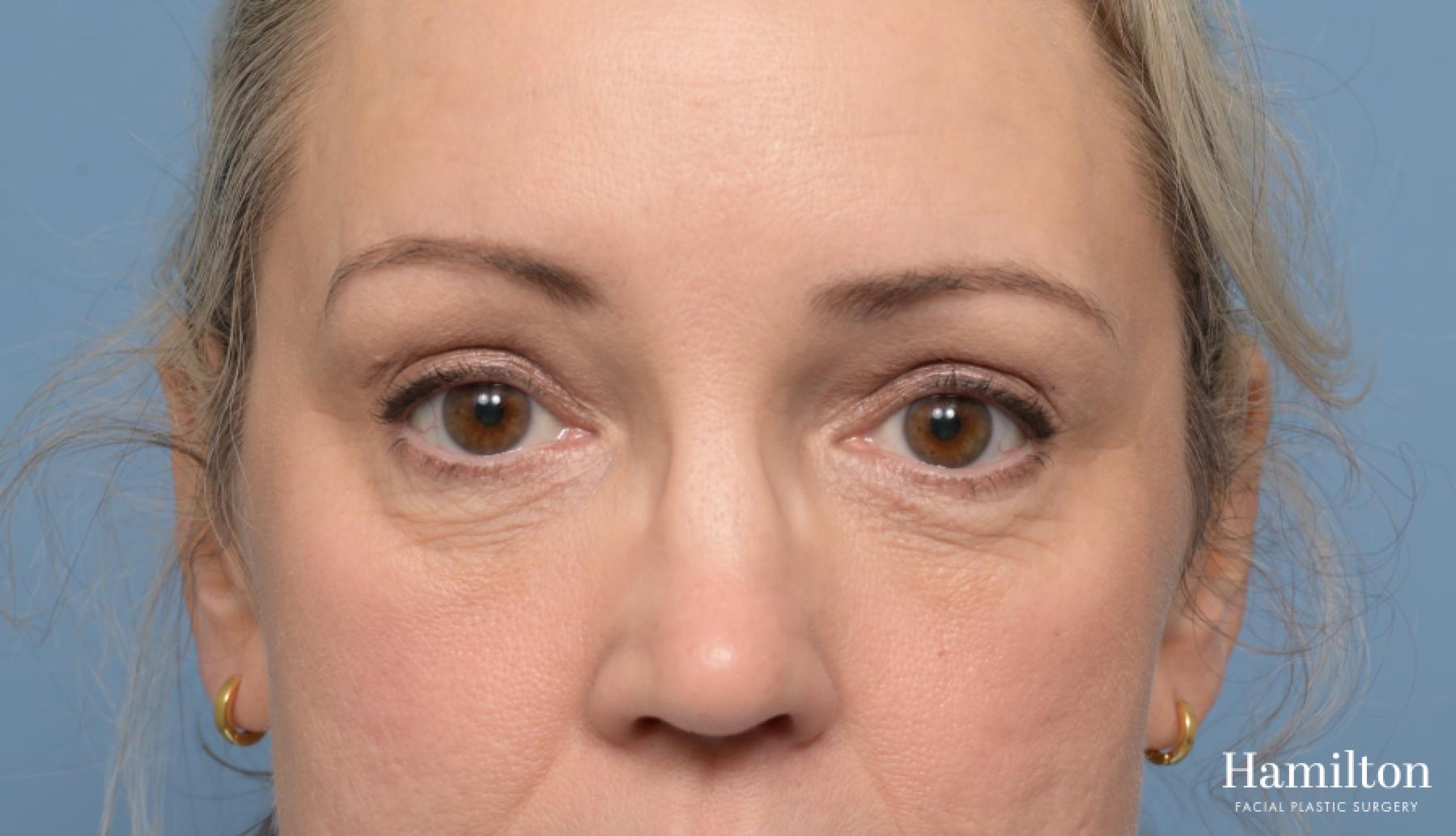 Blepharoplasty: Patient 5 - After 4