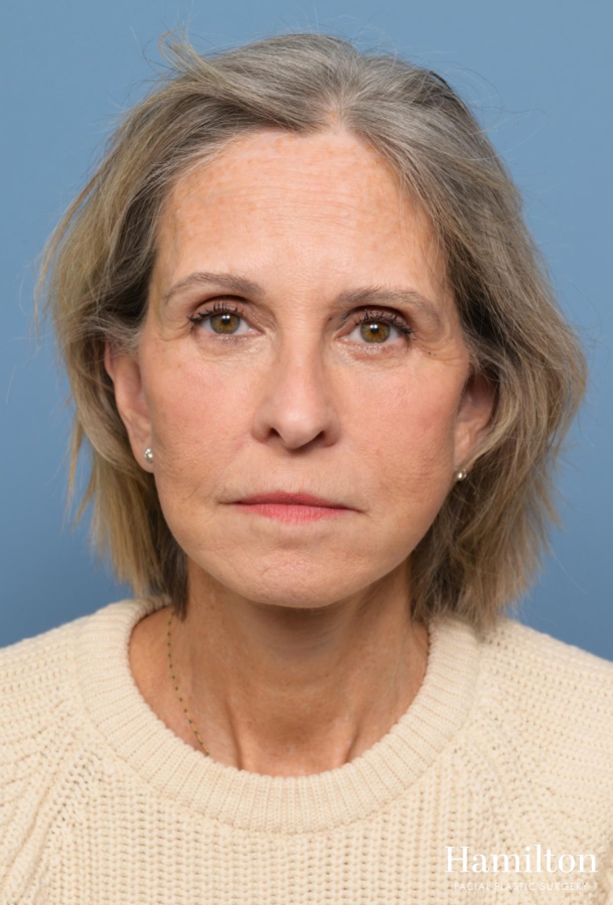 Fat Grafting: Patient 1 - After 1