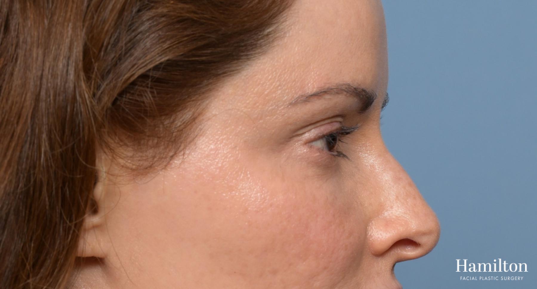 Blepharoplasty: Patient 6 - Before and After 5