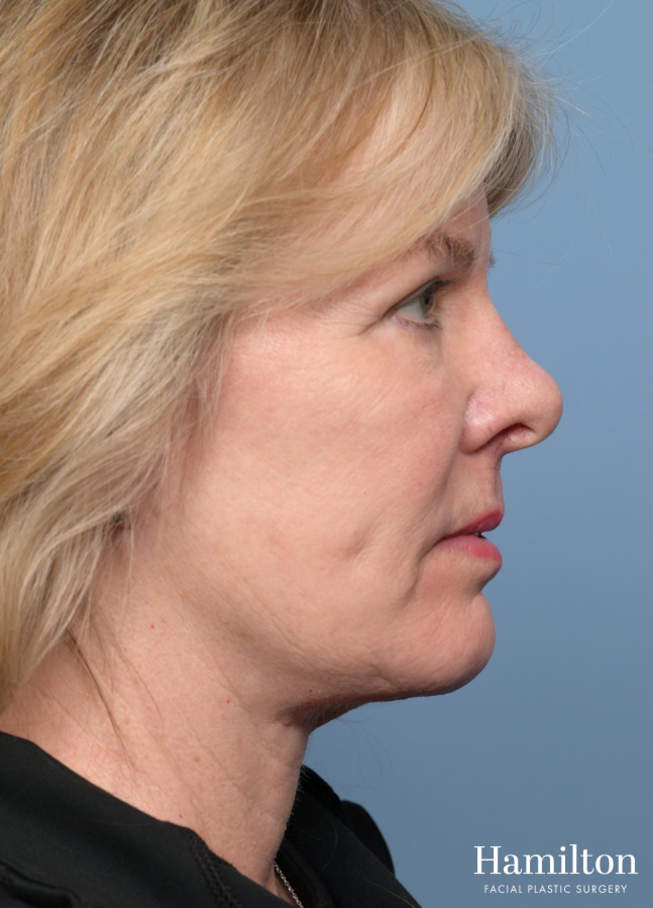 Facelift: Patient 43 - After 2