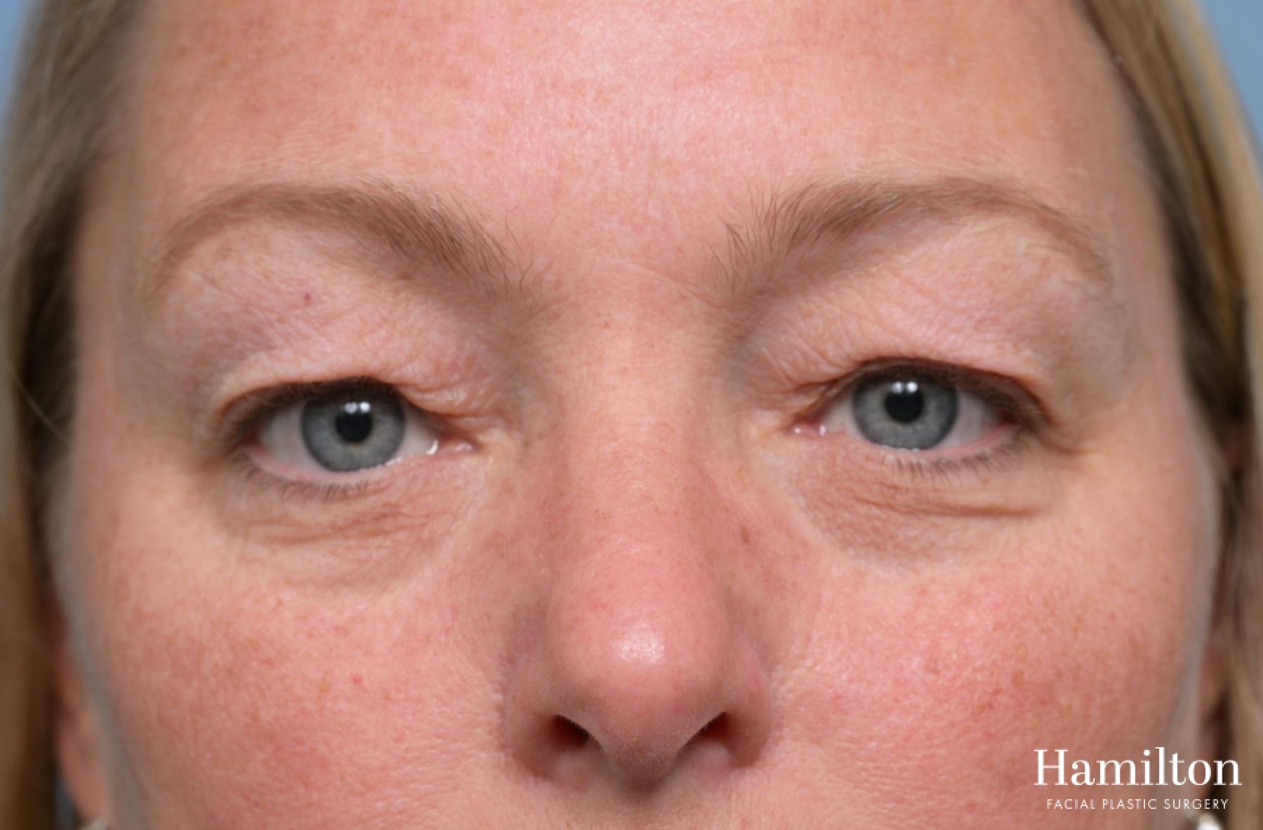 Blepharoplasty: Patient 2 - Before 