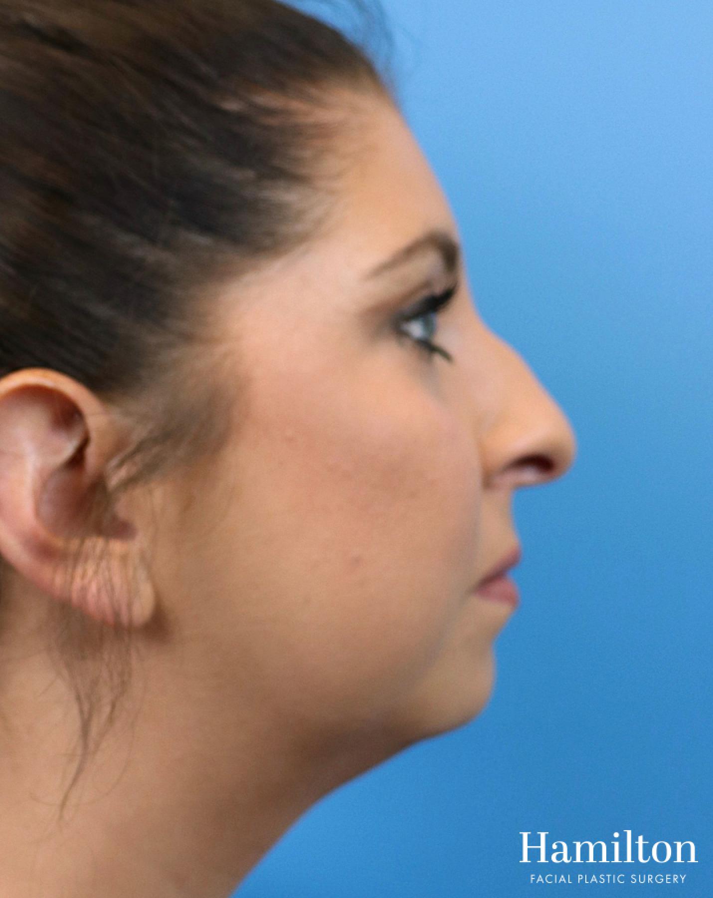 Chin Augmentation: Patient 10 - Before and After 5