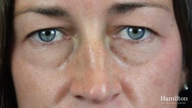 Fillers: Patient 5 - Before 1