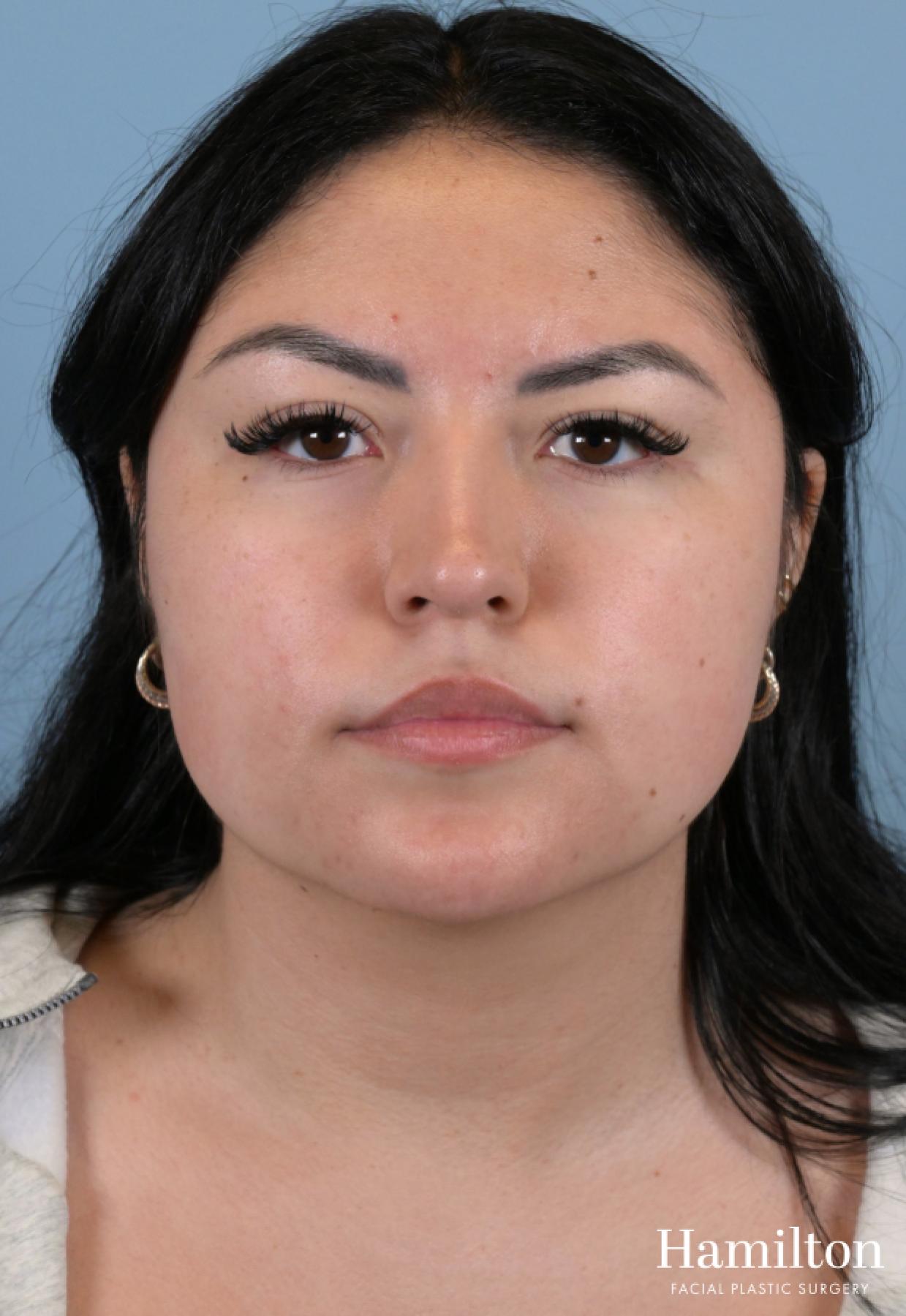 Buccal Fat Removal: Patient 1 - After 1
