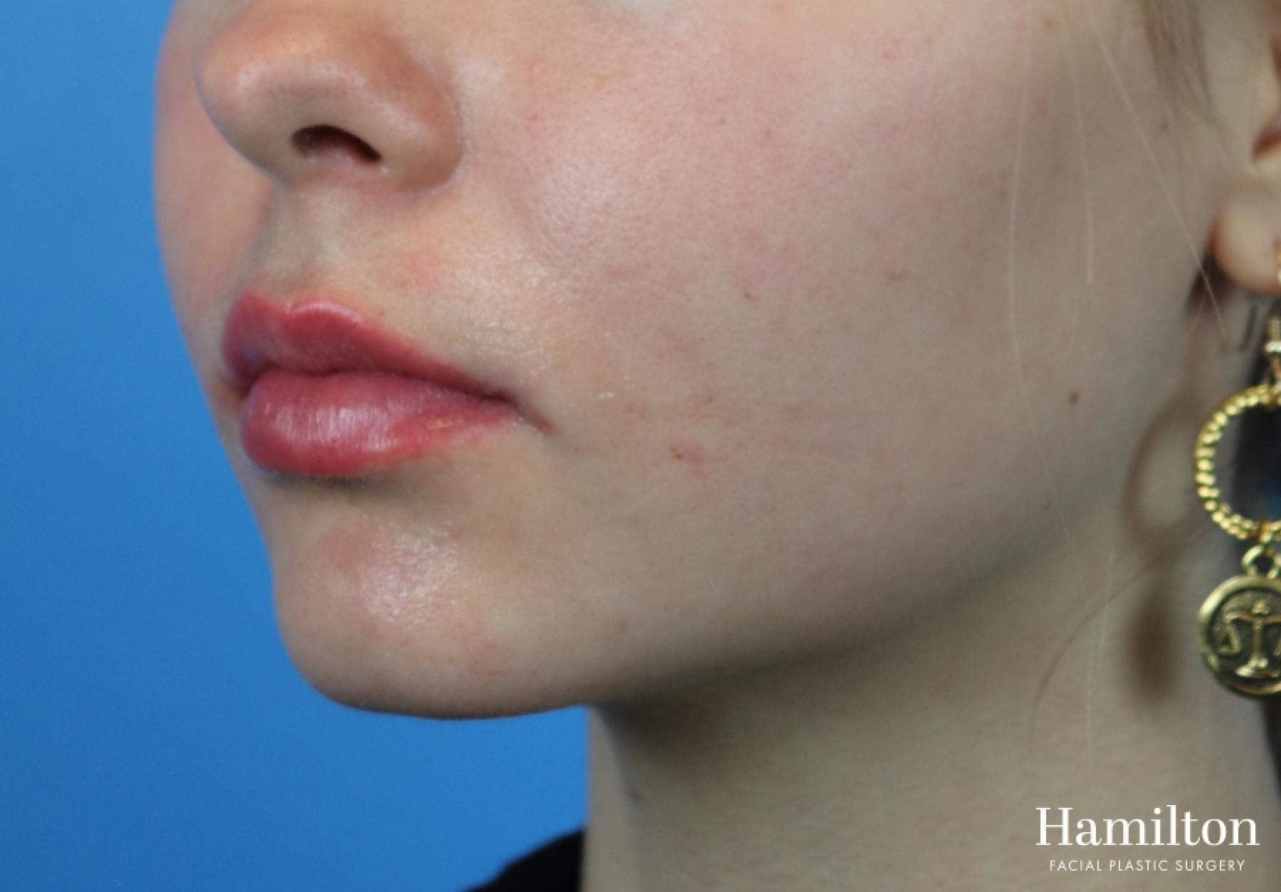 Lip Enhancement: Patient 2 - After 3