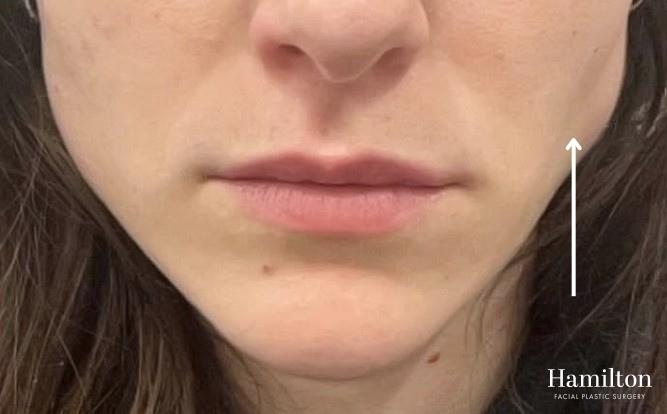 Neurotoxins/Botox: Patient 11 - Before 1