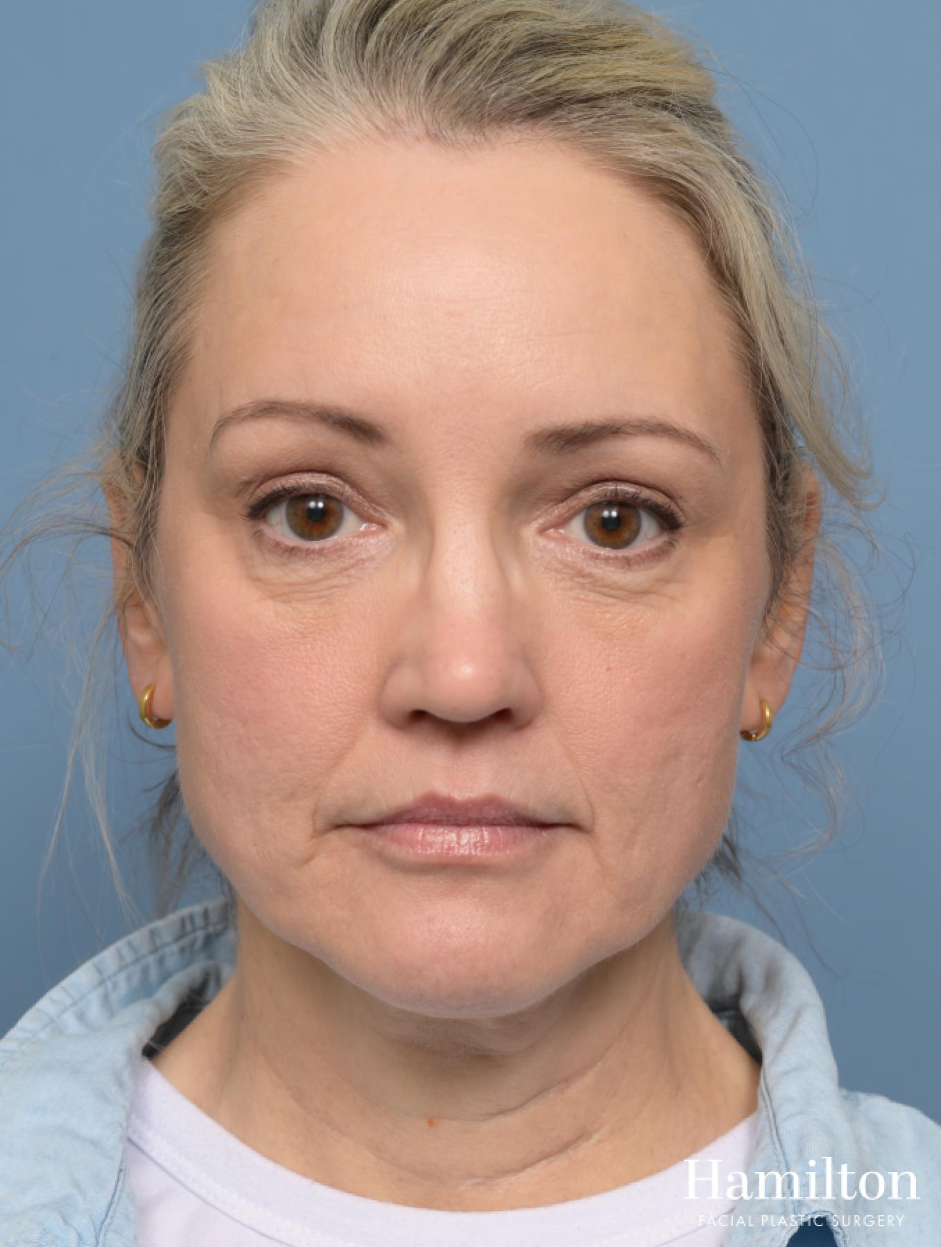 Brow Lift: Patient 3 - After  