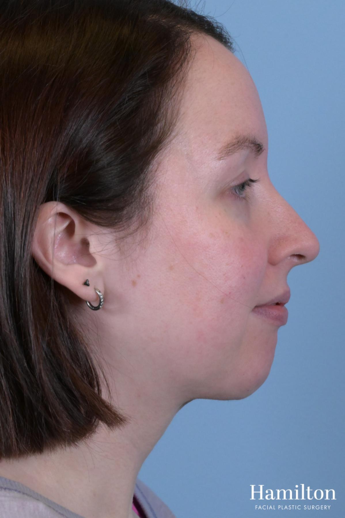 Submentoplasty/Deep Neck Lift: Patient 1 - After 2