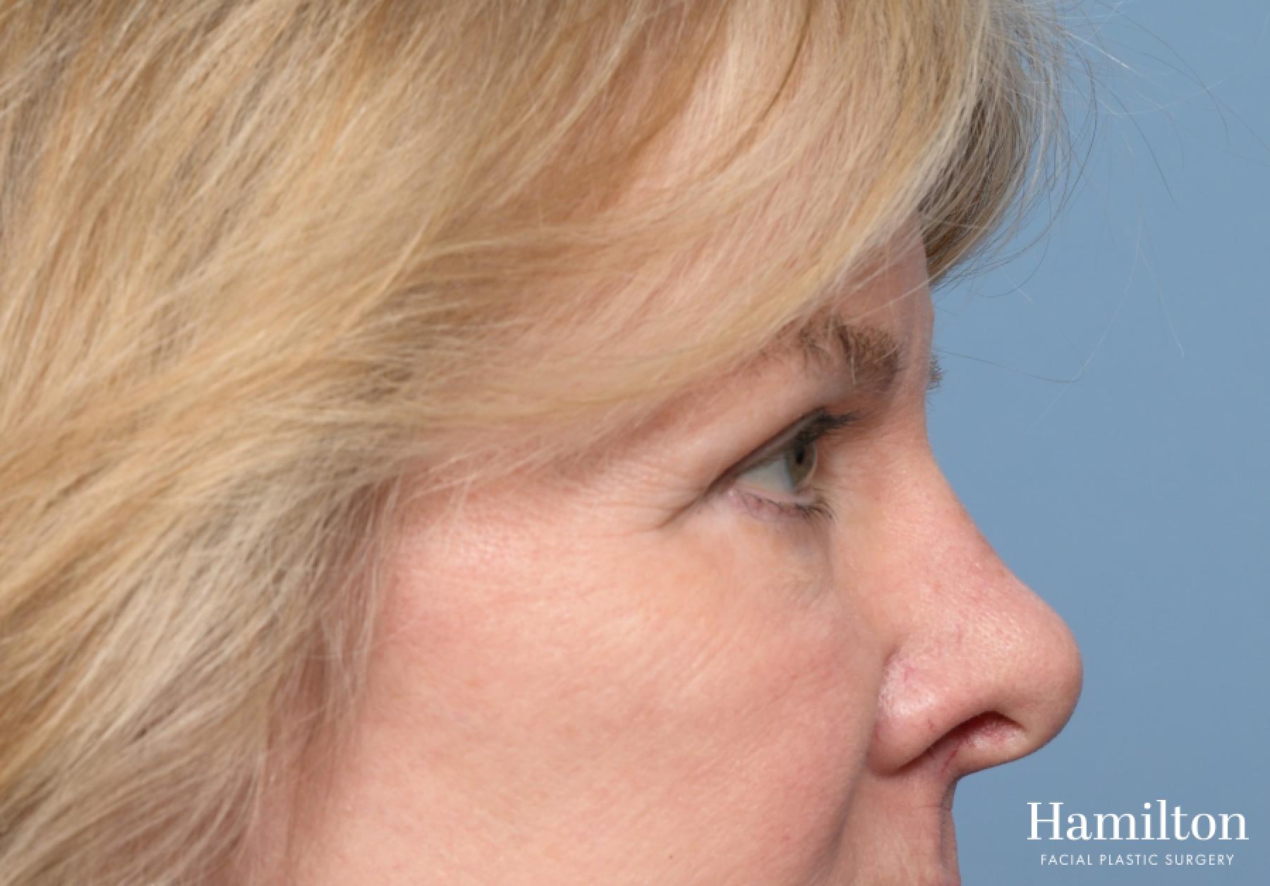 Blepharoplasty: Patient 11 - After 2