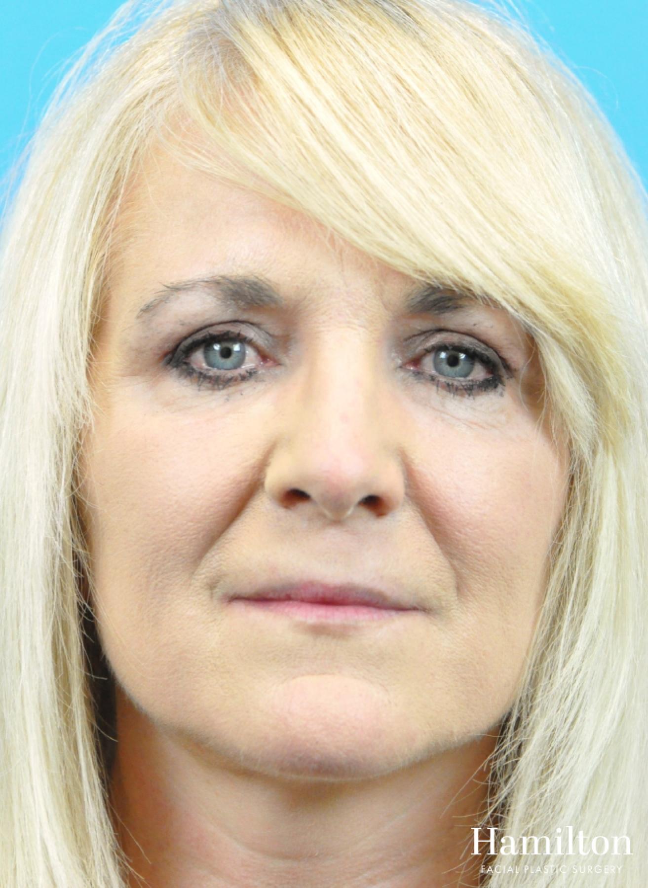 Lip Enhancement: Patient 10 - Before 