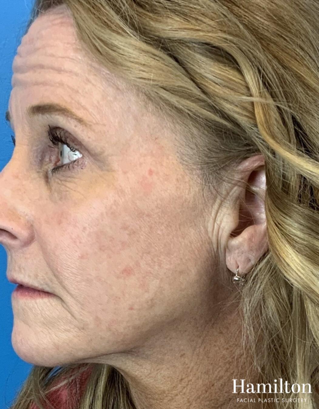 HALO Laser: Patient 3 - After 3