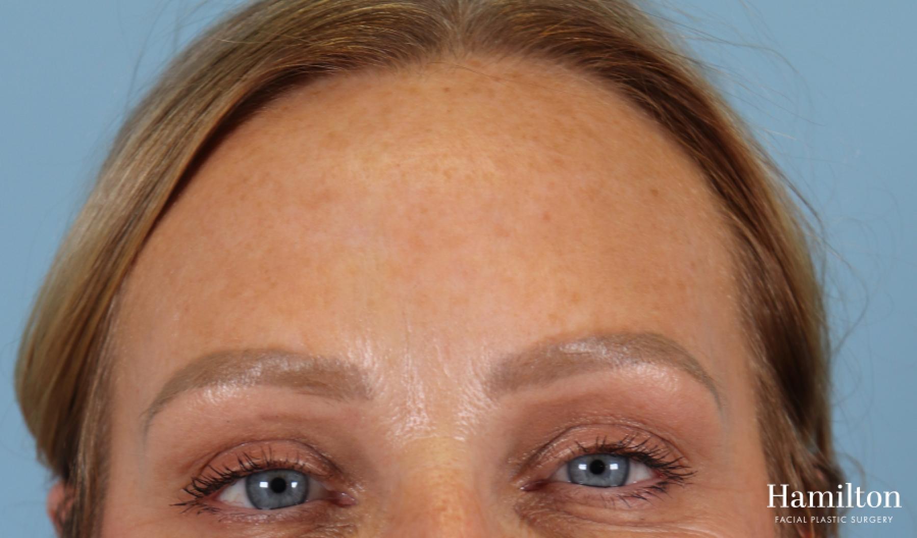 Neurotoxins/Botox: Patient 5 - After  