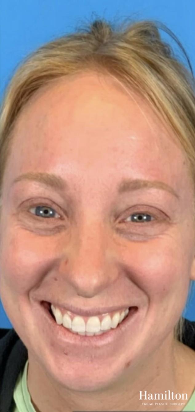 MOXI Laser: Patient 2 - After  