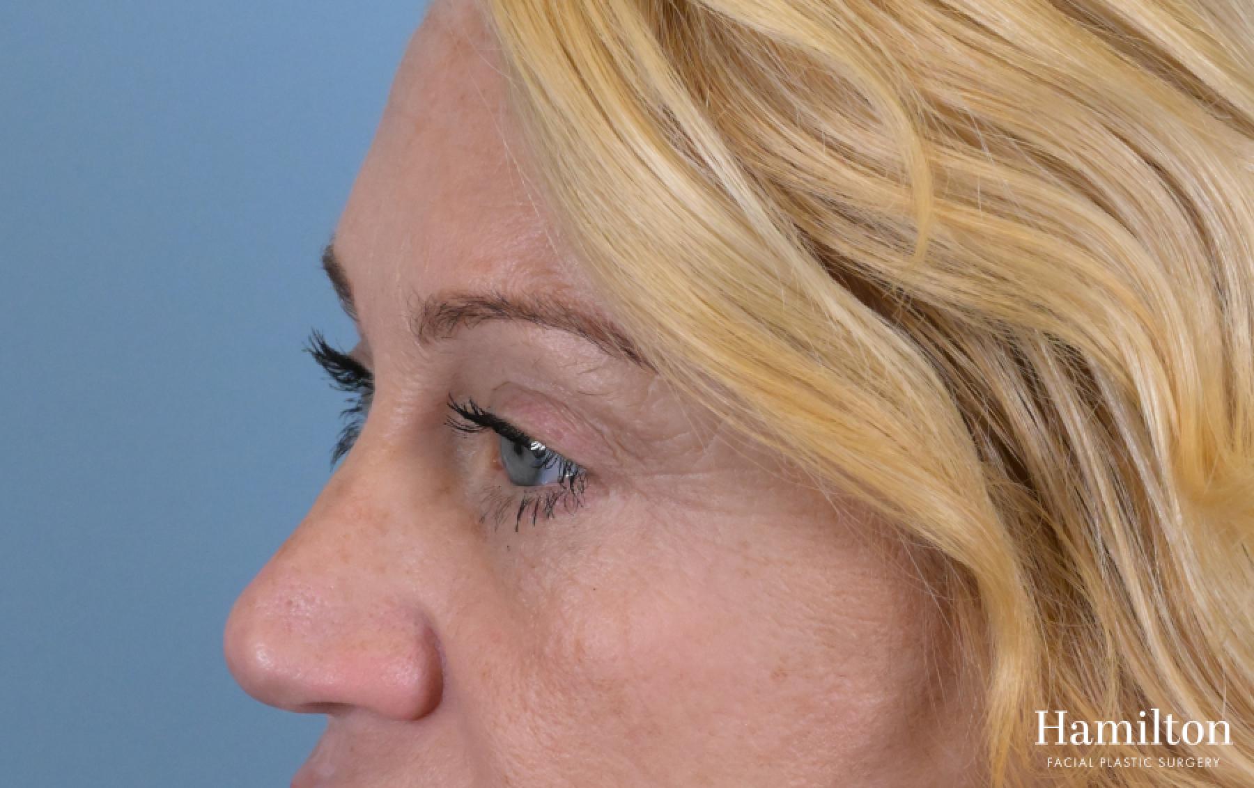 Blepharoplasty: Patient 23 - After 1