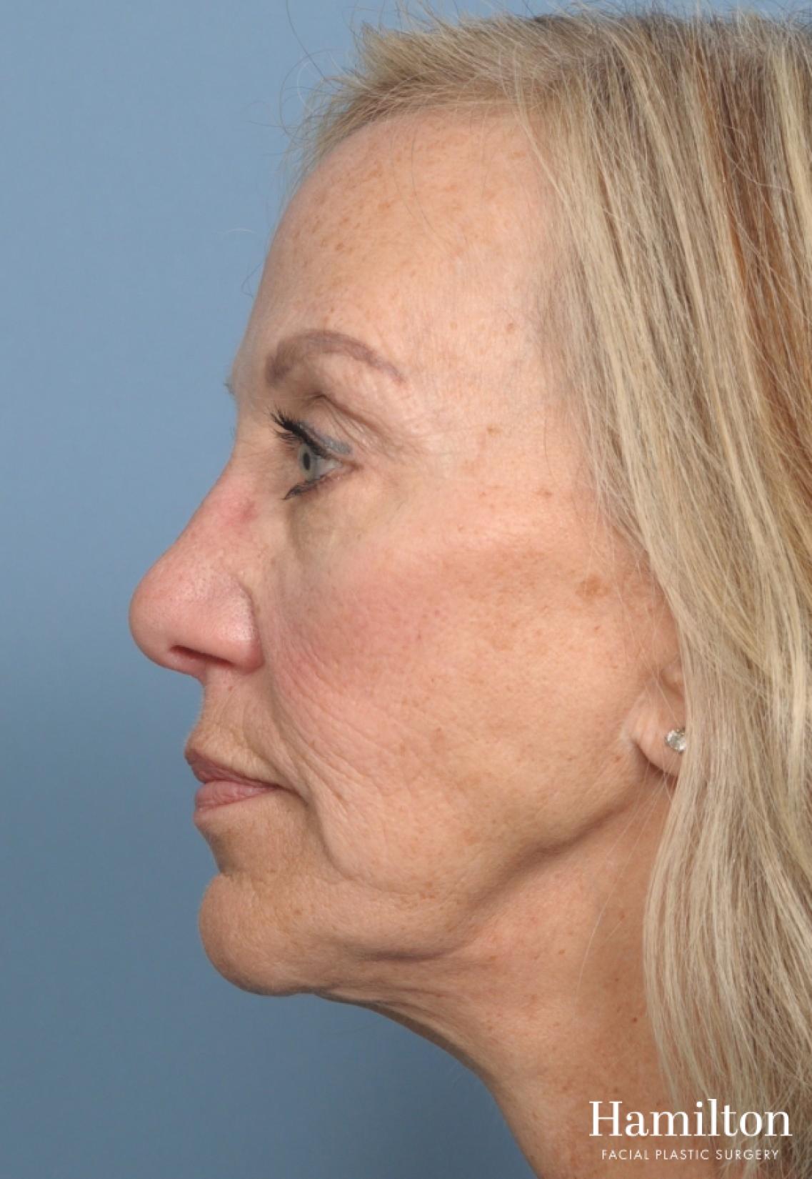 Mini Facelift: Patient 1 - Before 
