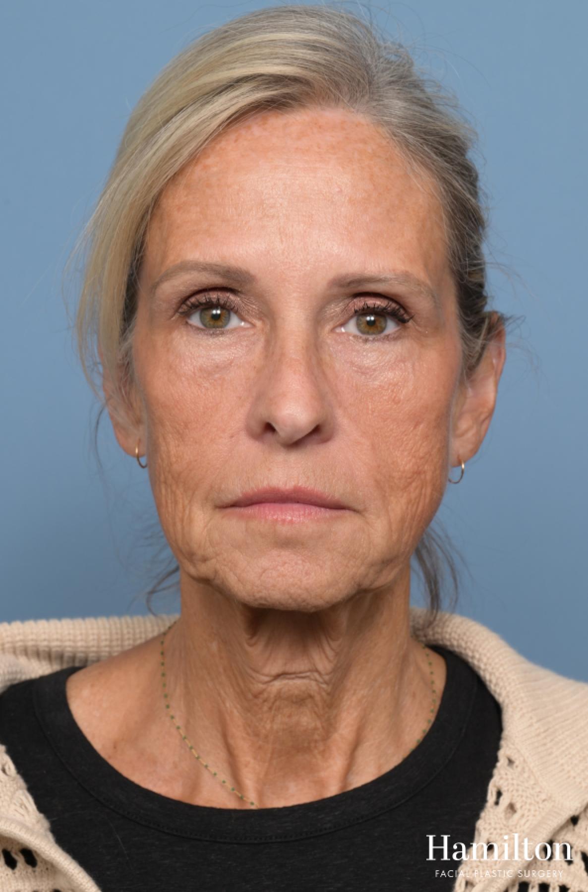 Fat Grafting: Patient 1 - Before 