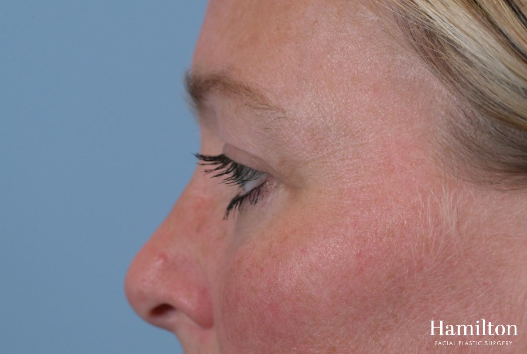 Blepharoplasty: Patient 2 - After 4