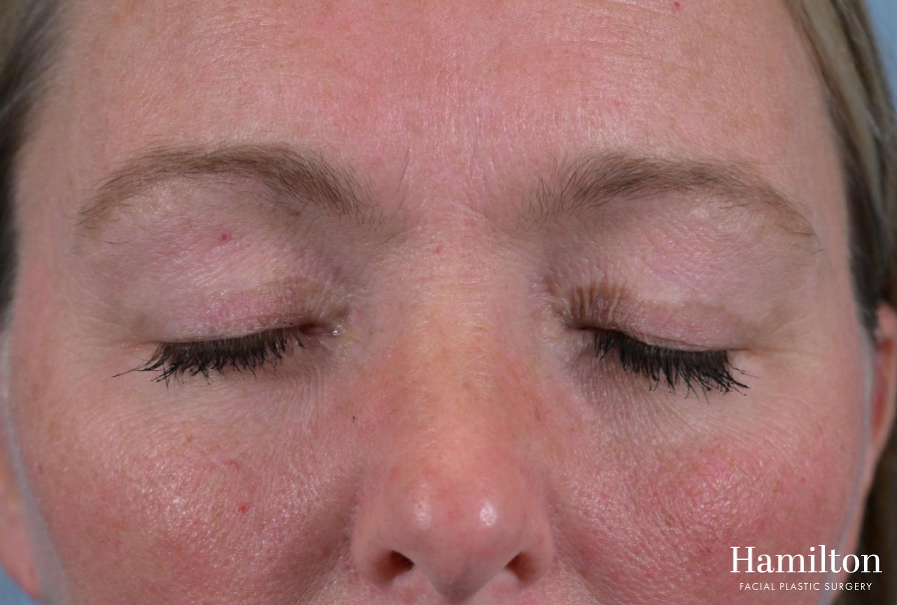 Blepharoplasty: Patient 2 - After 7