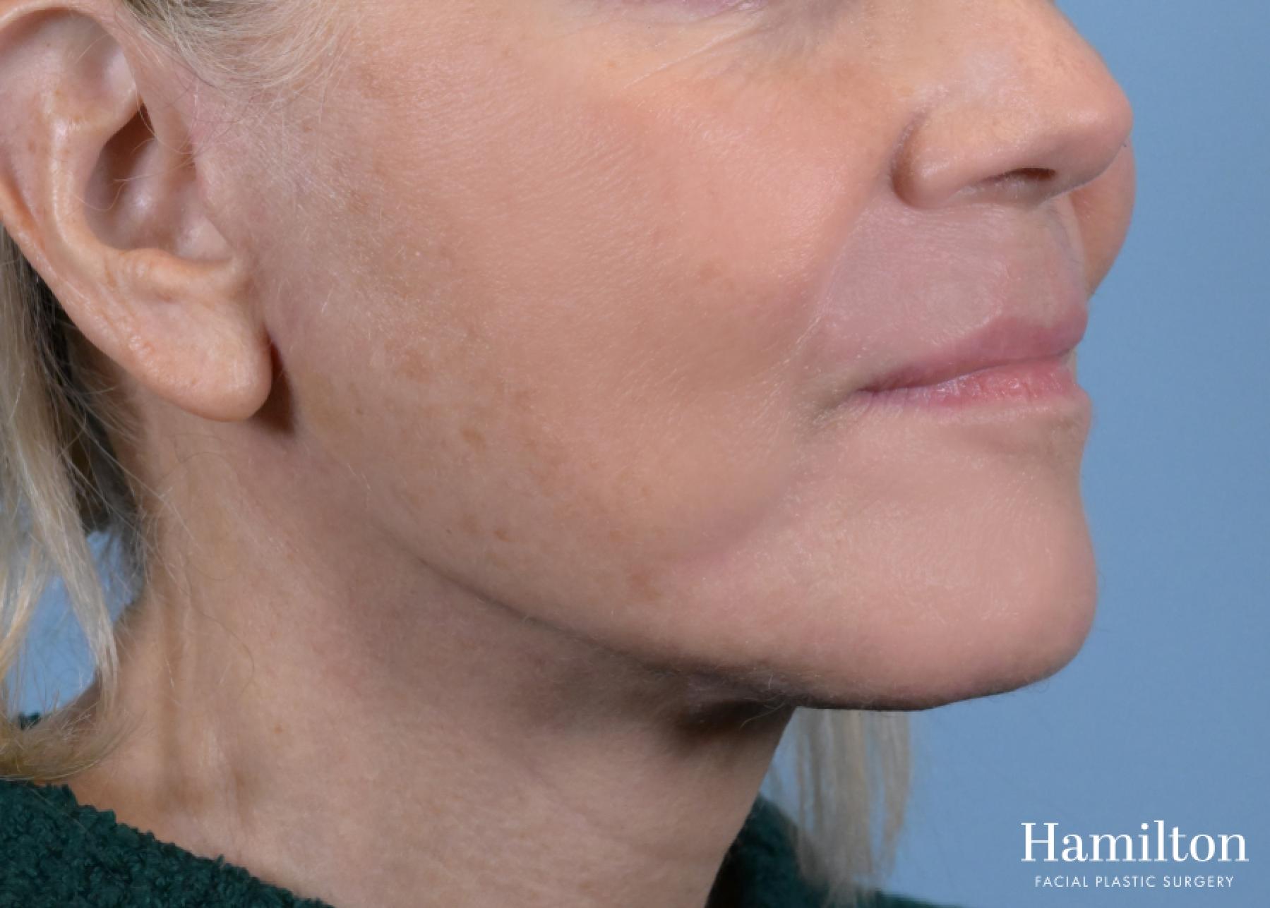 Sciton Laser: Patient 1 - After 3