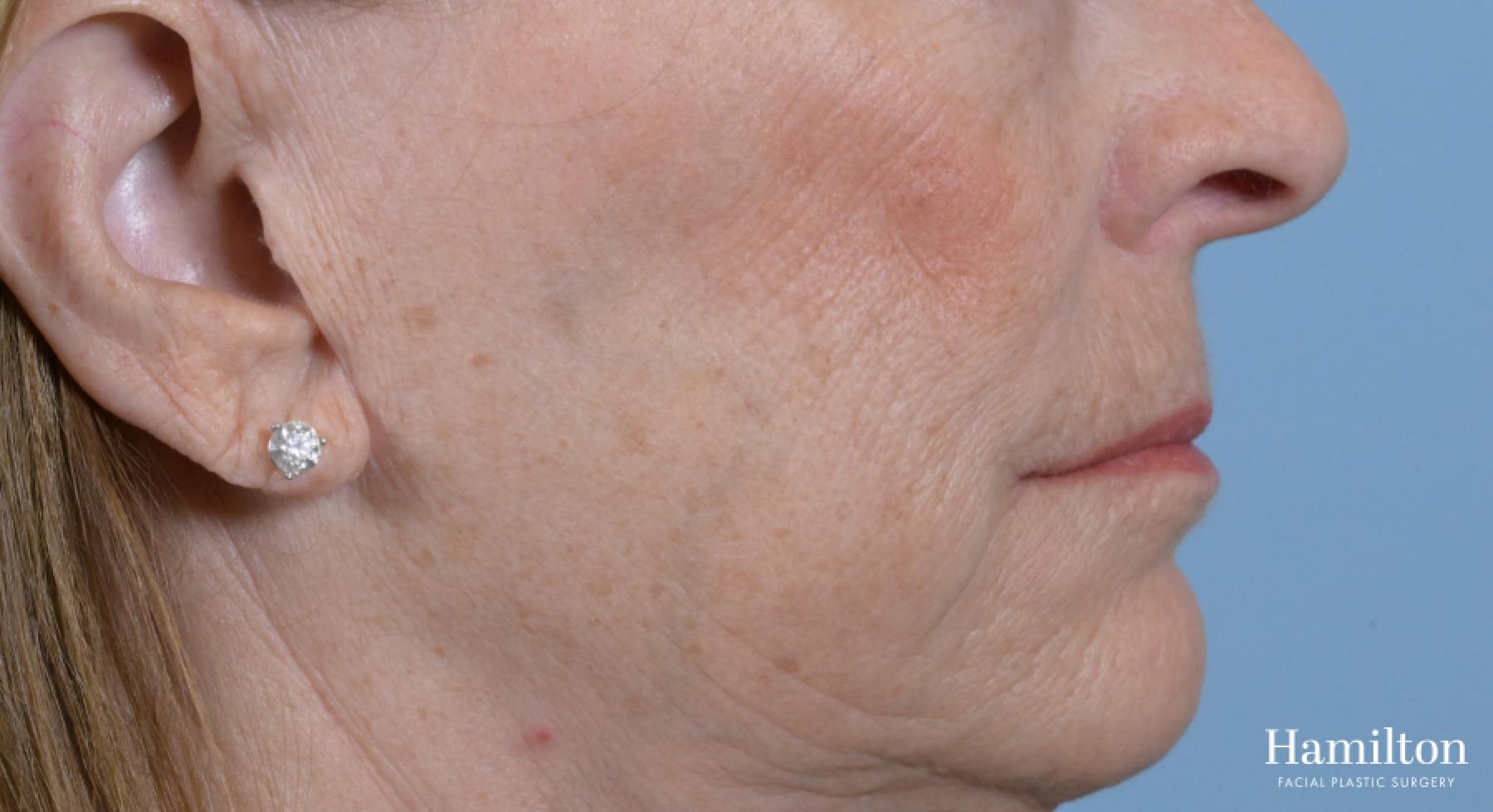 Sciton Laser: Patient 2 - Before and After 6