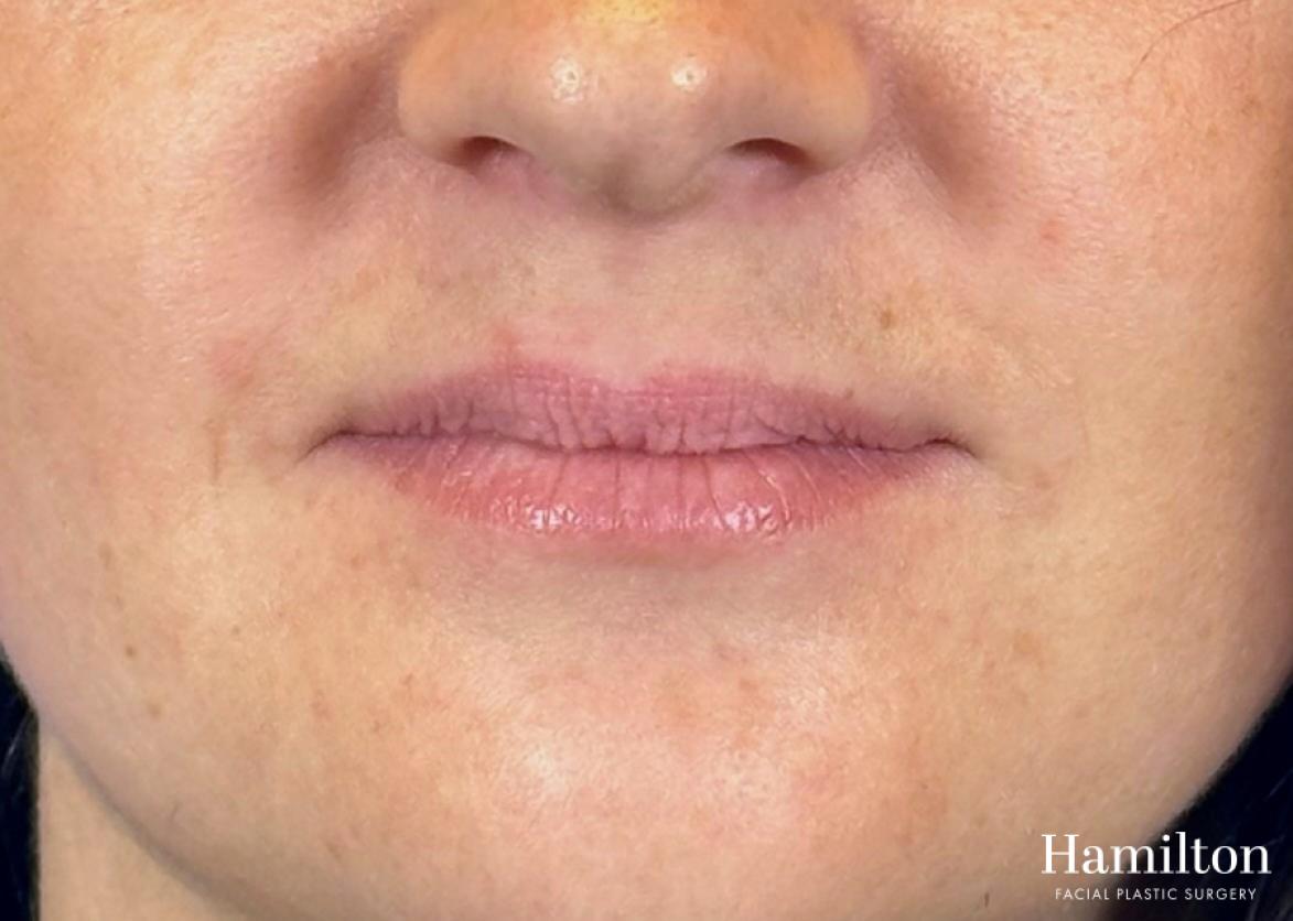Lip Enhancement: Patient 5 - Before and After 2