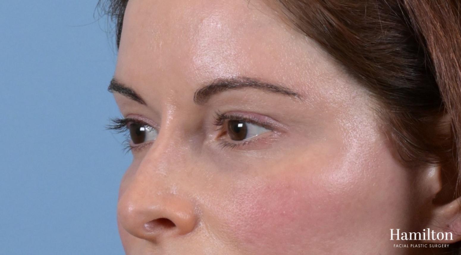 Blepharoplasty: Patient 6 - After  