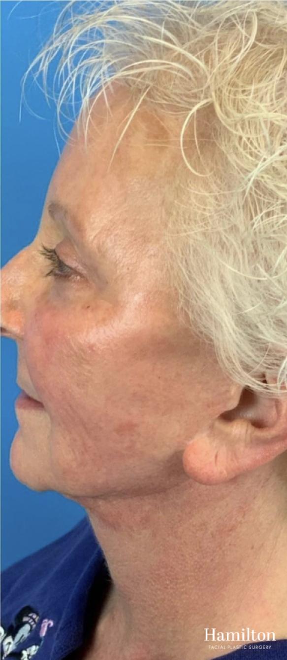 Broad Band Light (BBL): Patient 4 - After  
