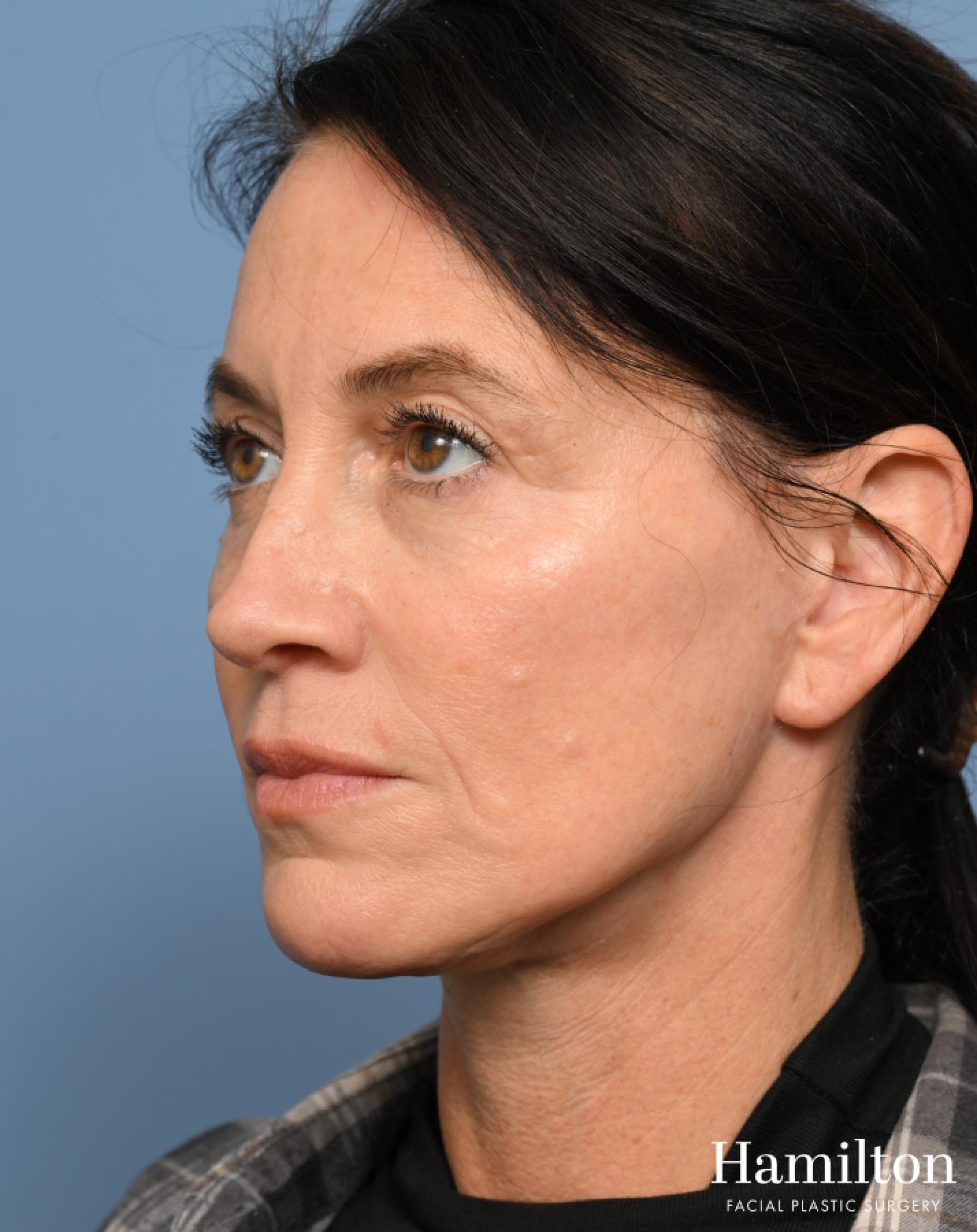 Facelift: Patient 29 - After 1