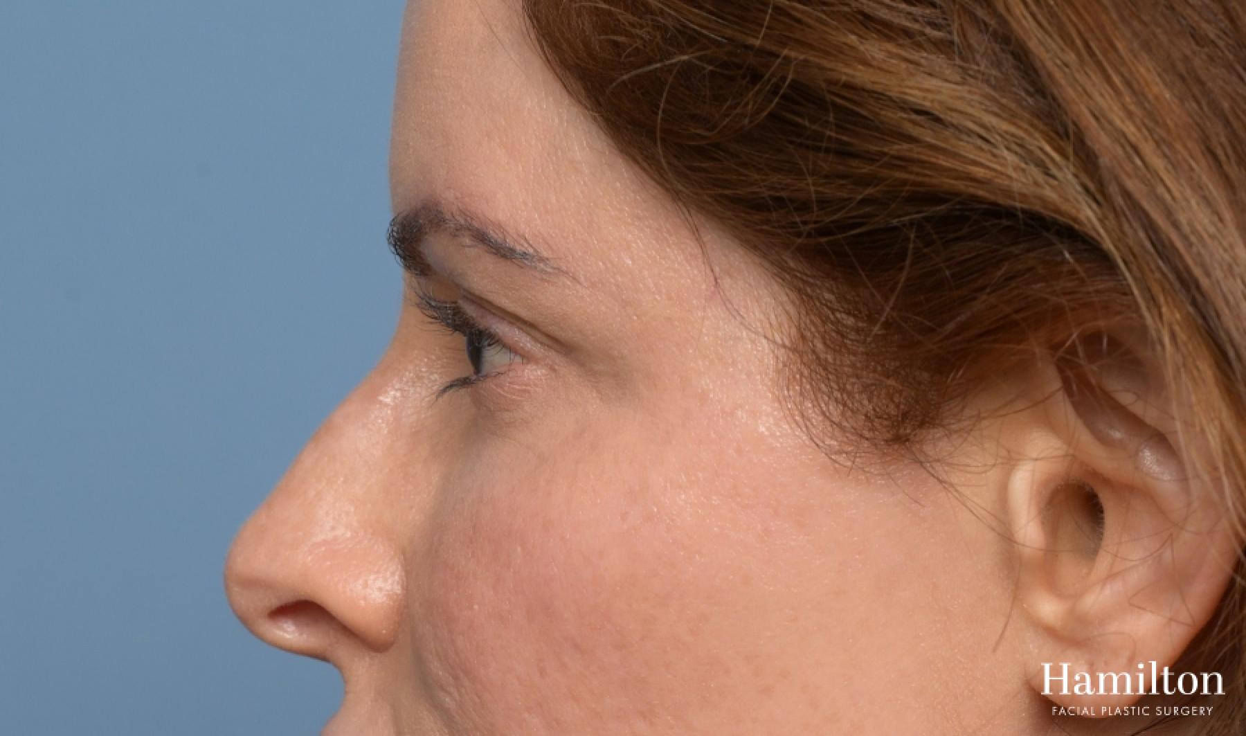Blepharoplasty: Patient 6 - Before 3