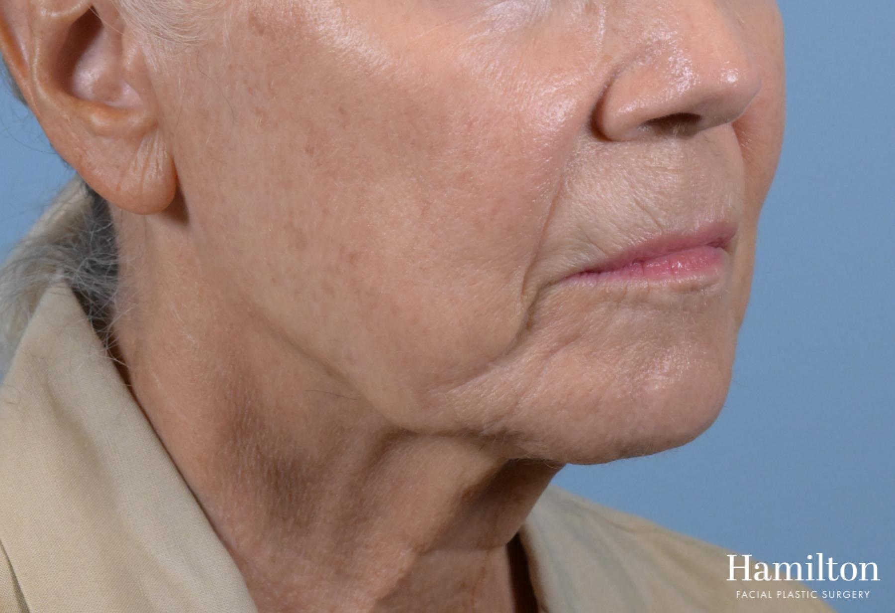 Sciton Laser: Patient 1 - Before and After 3