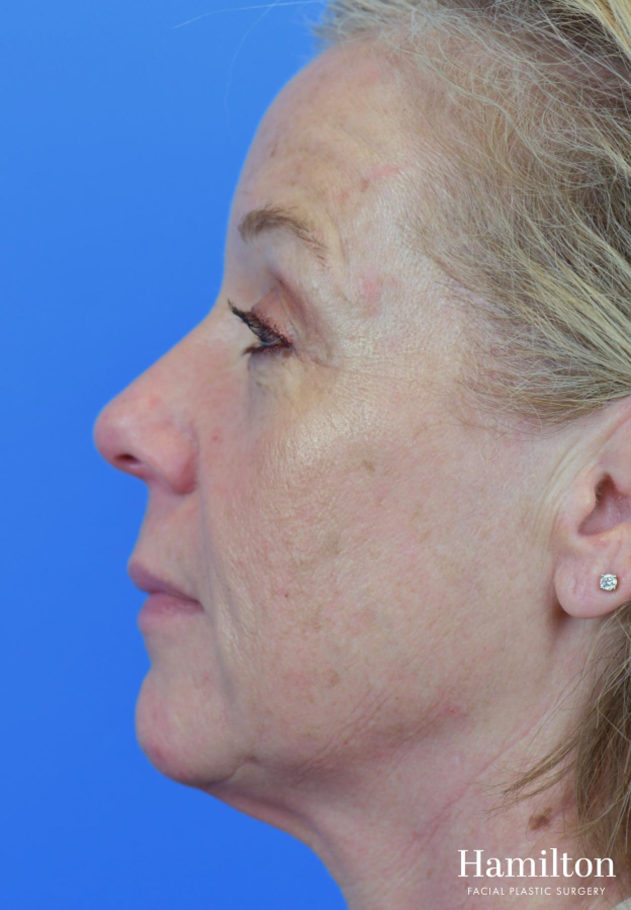 Facelift: Patient 37 - Before and After 5
