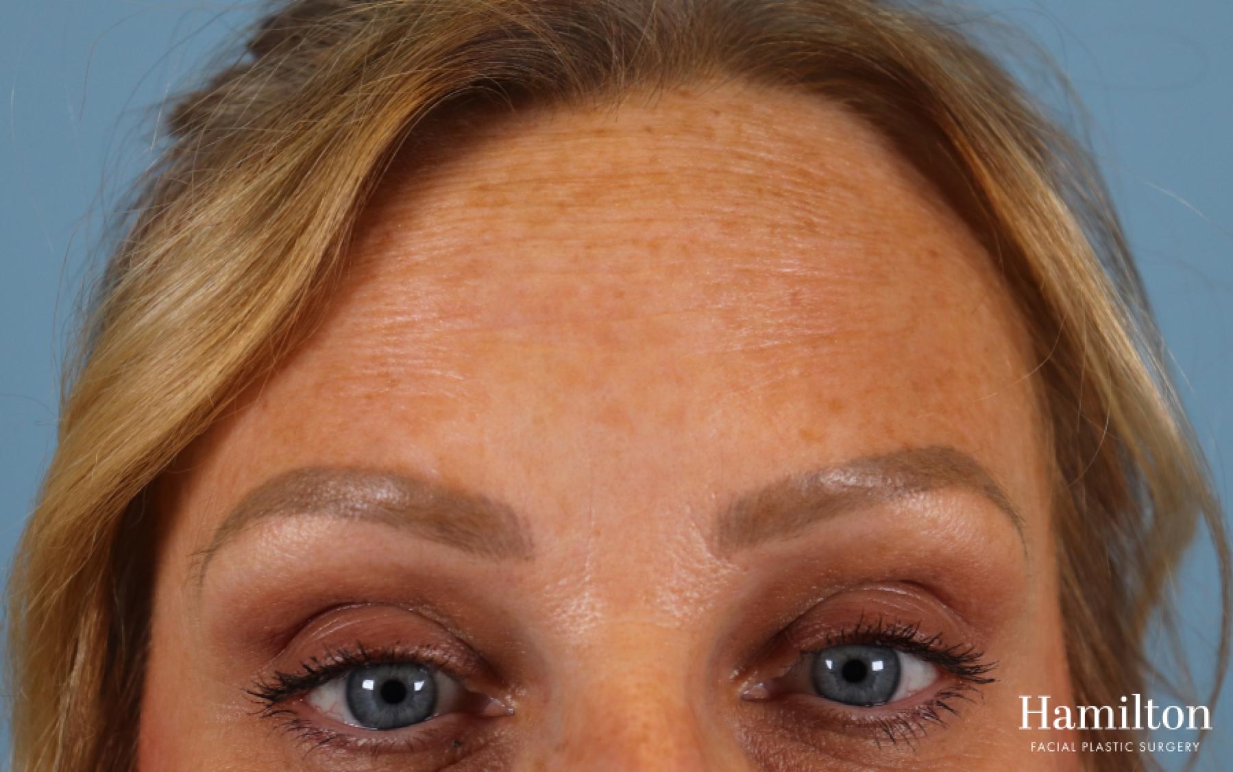 Neurotoxins/Botox: Patient 5 - Before 