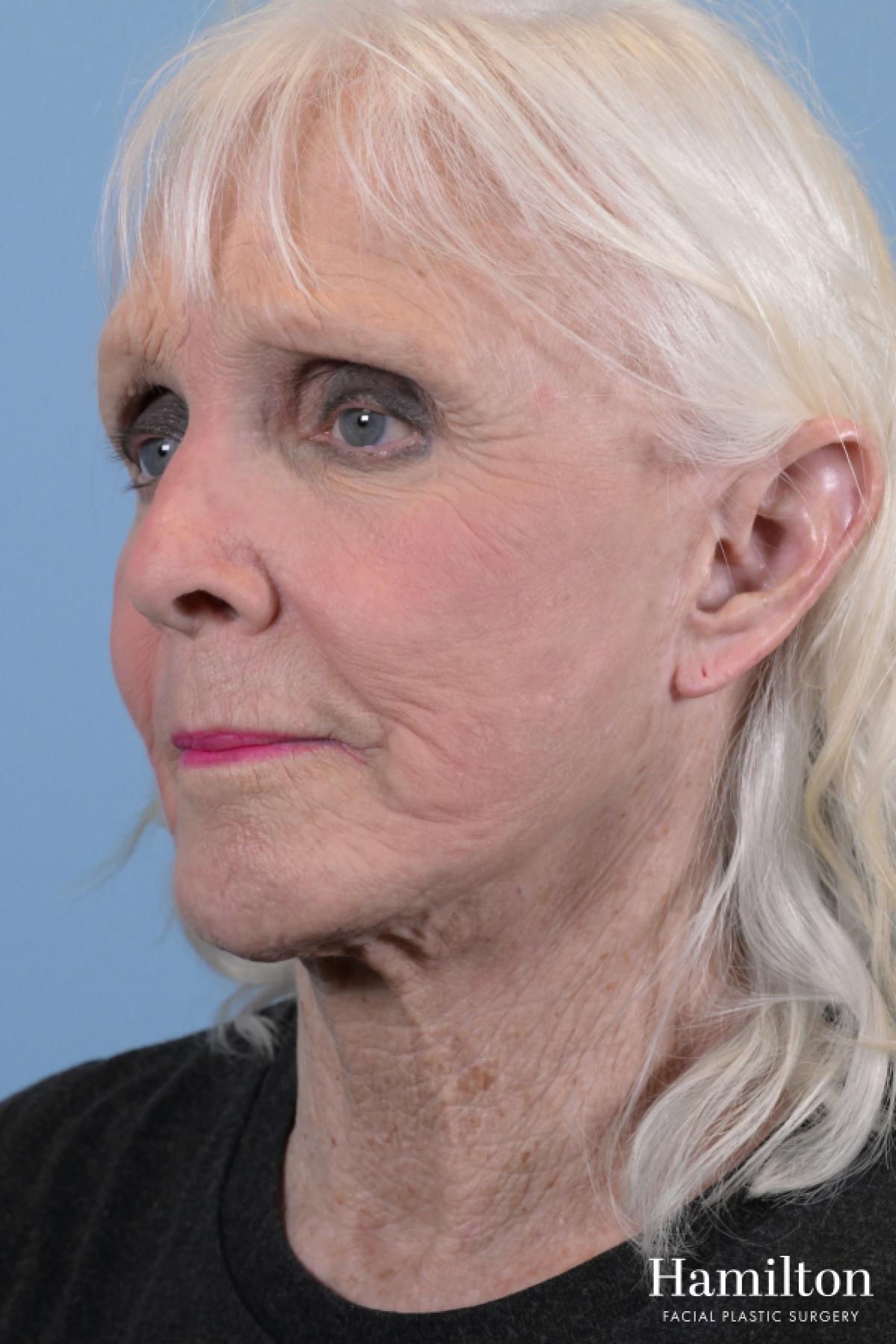 C02 Laser: Patient 7 - Before