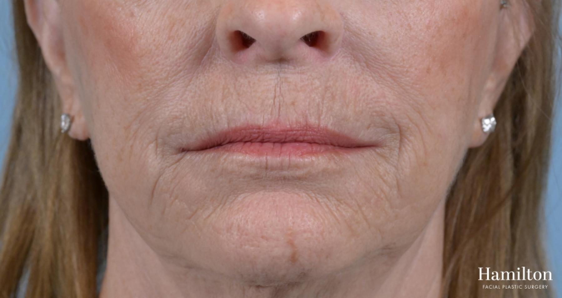 Sciton Laser: Patient 2 - Before 2