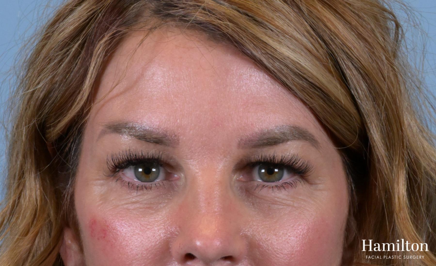 Blepharoplasty: Patient 8 - Before 