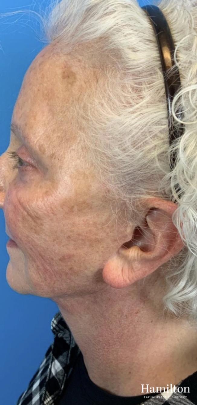 HALO Laser: Patient 1 - Before 