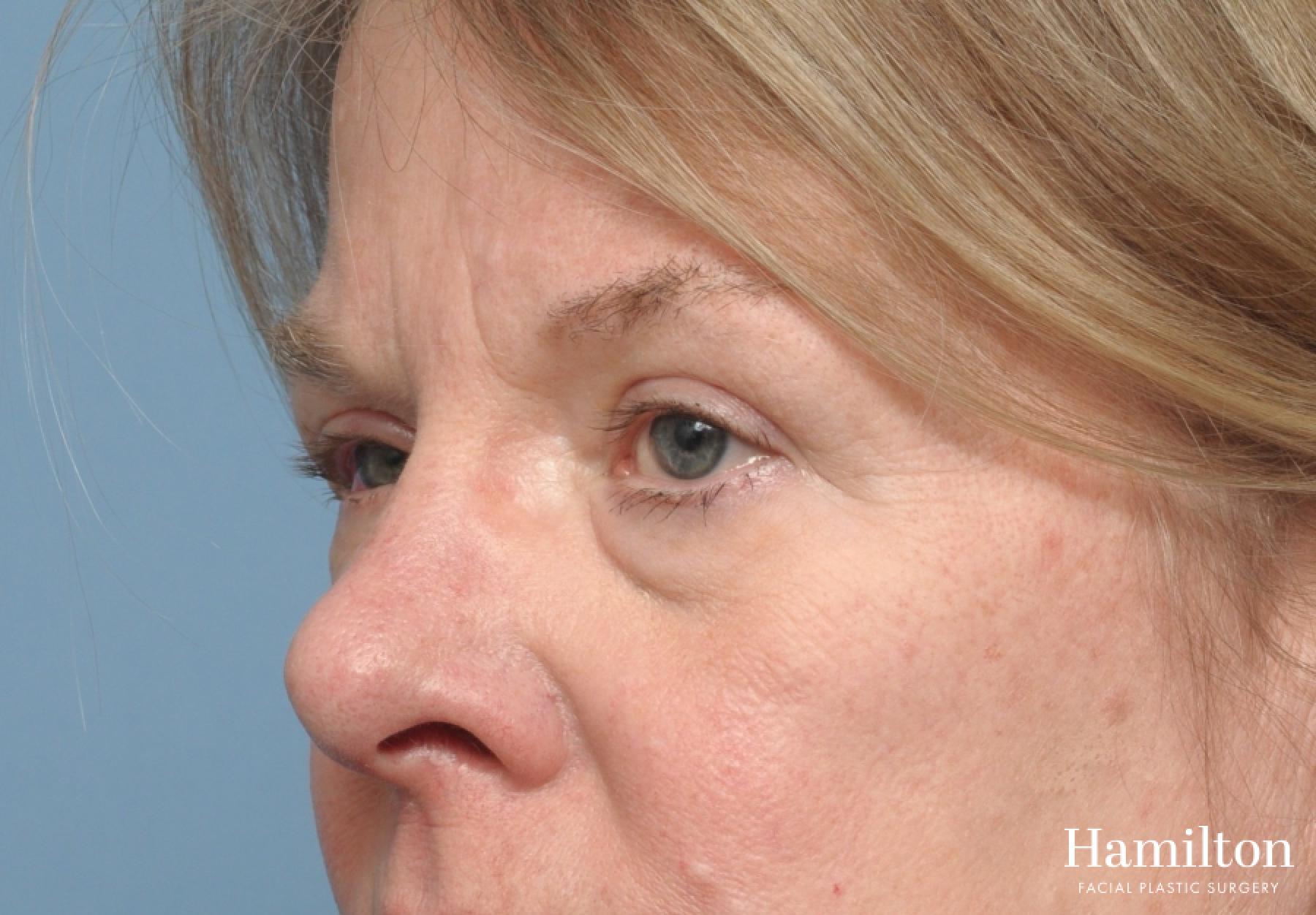Blepharoplasty: Patient 11 - Before 3