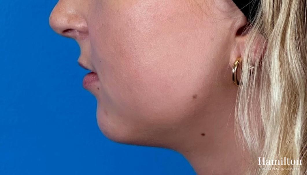 Fillers: Patient 2 - Before and After 3