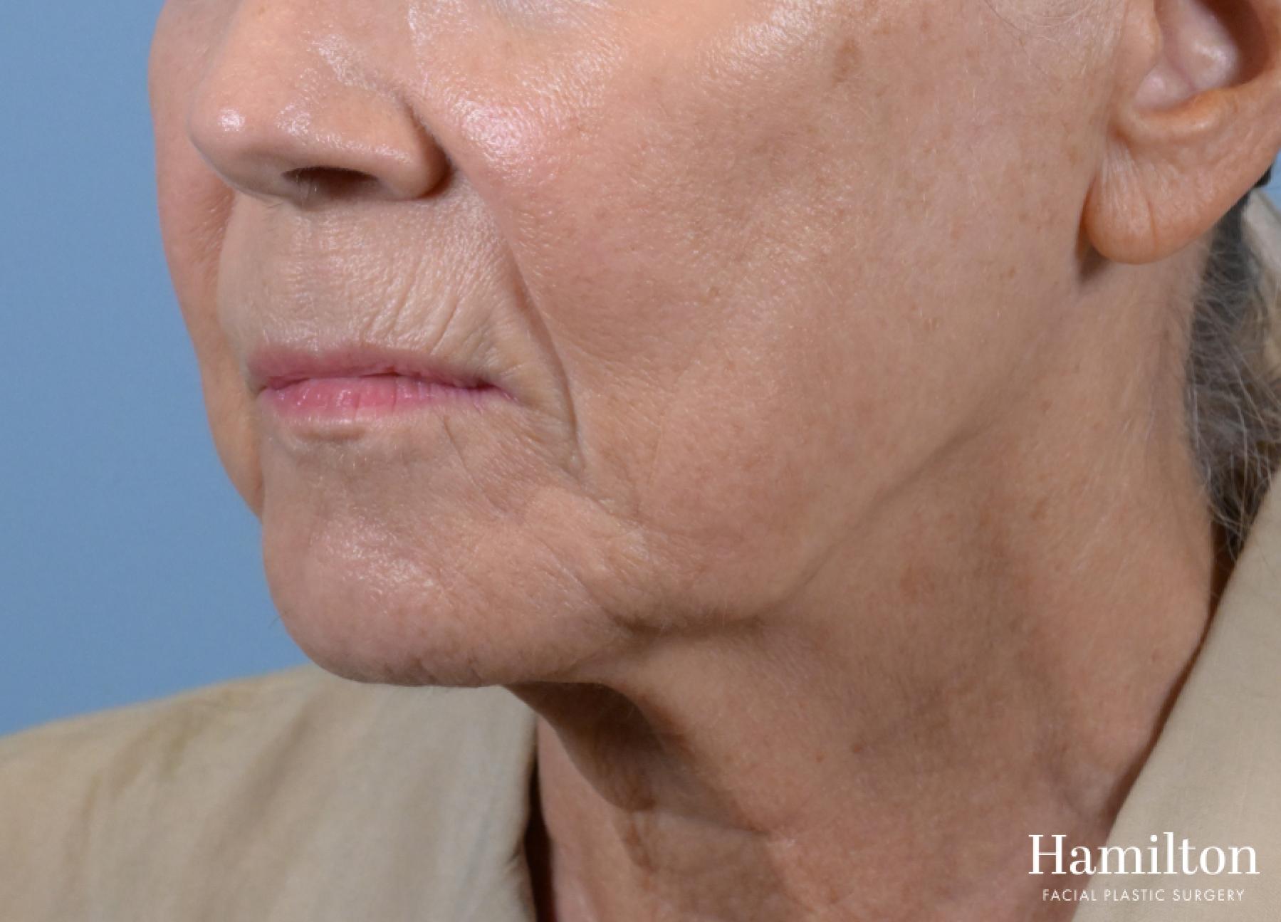 Sciton Laser: Patient 1 - Before 2