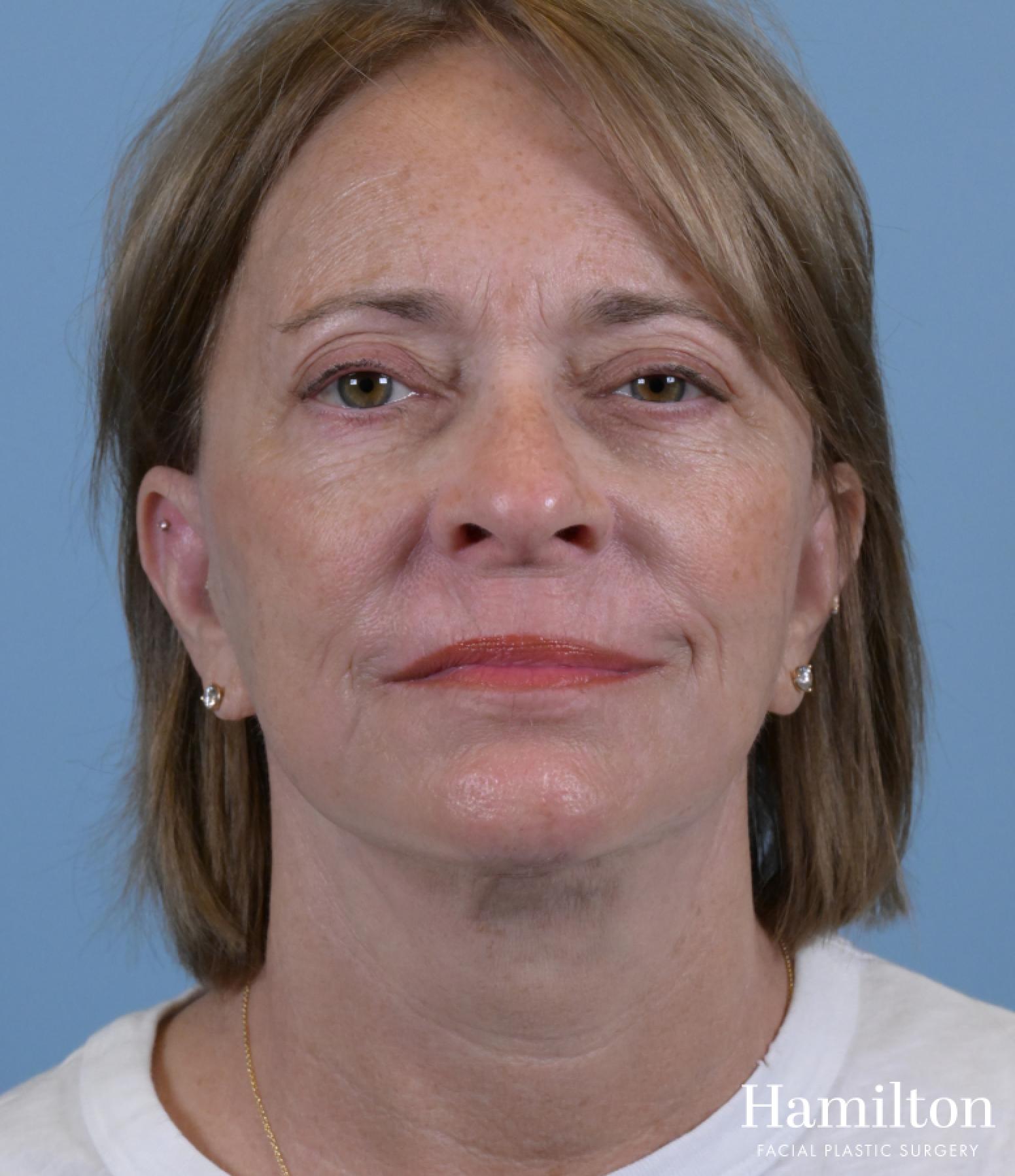 Sciton Laser: Patient 2 - After 1