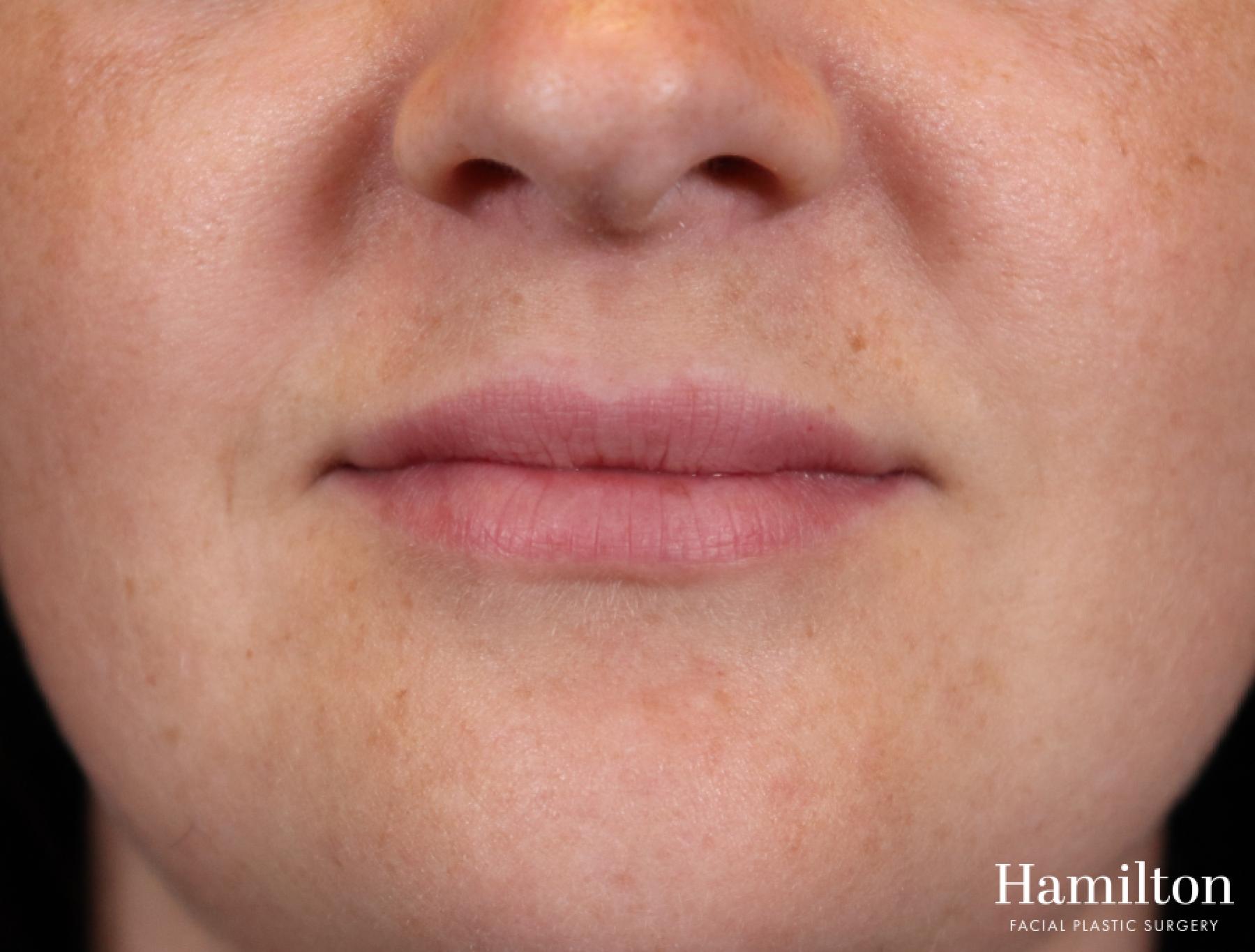 Lip Enhancement: Patient 5 - After 2