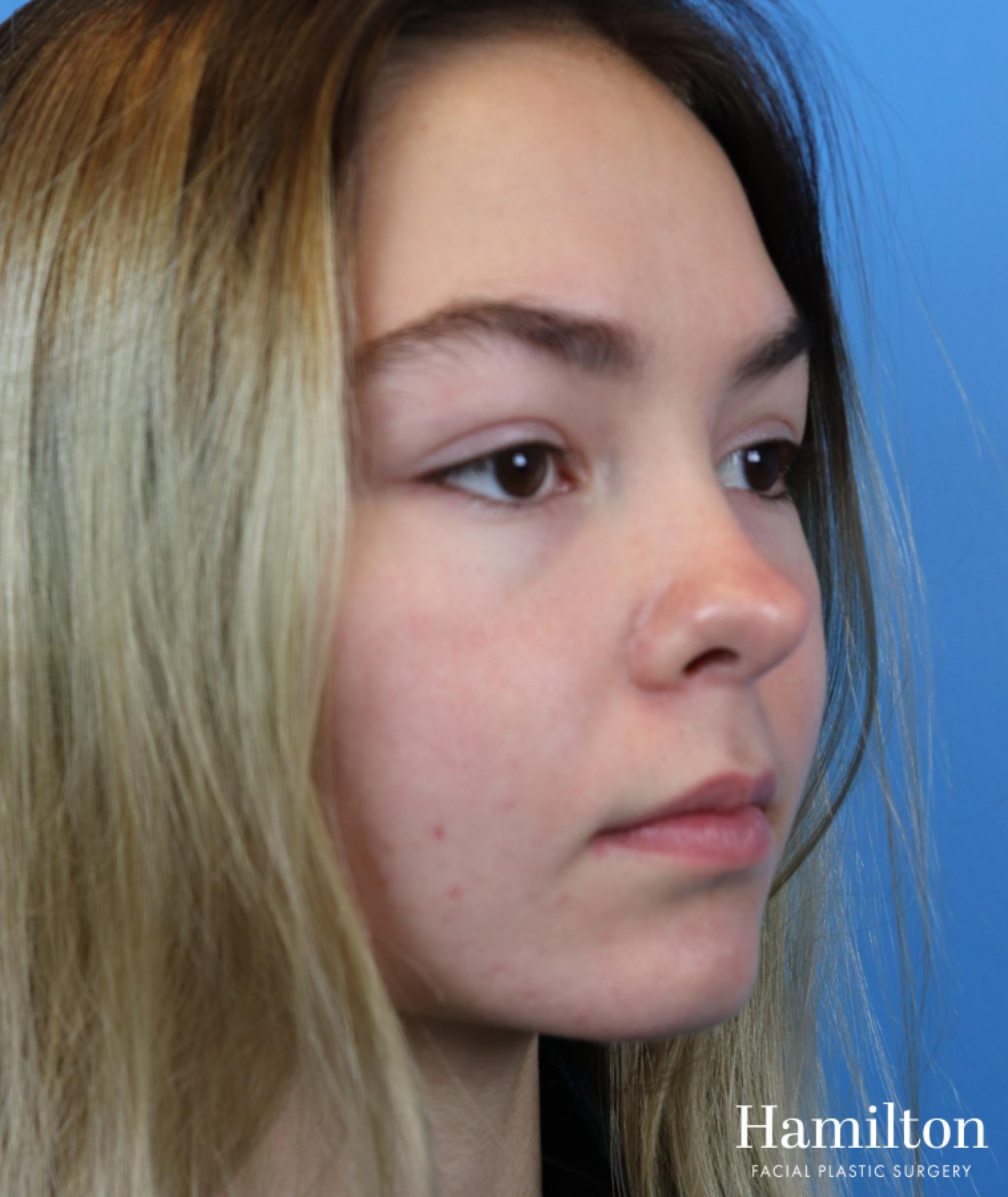 Lip Enhancement: Patient 2 - Before and After 4