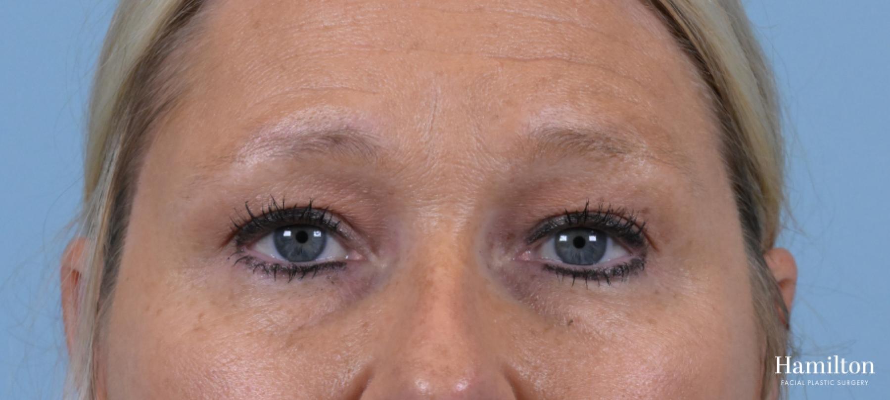 Blepharoplasty: Patient 15 - Before