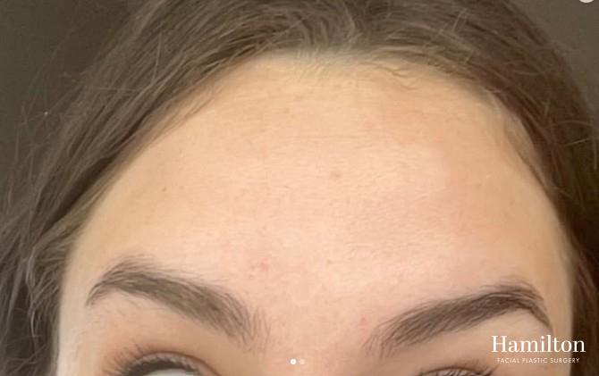 Neurotoxins/Botox: Patient 8 - After  