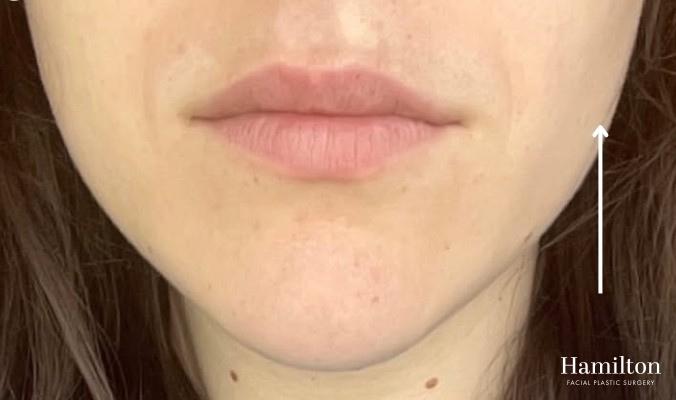BOTOX® Cosmetic: Patient 12 - After 1
