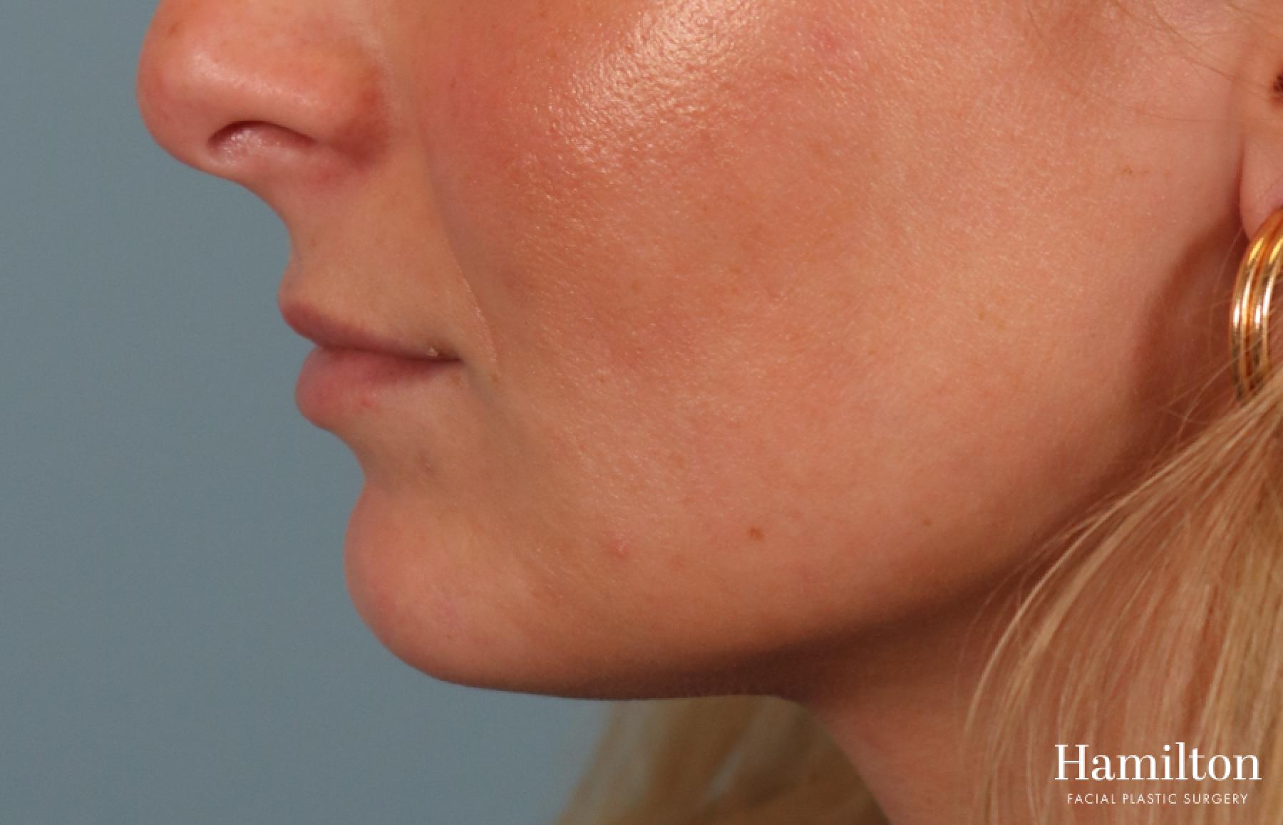 Lip Enhancement: Patient 7 - Before and After 4
