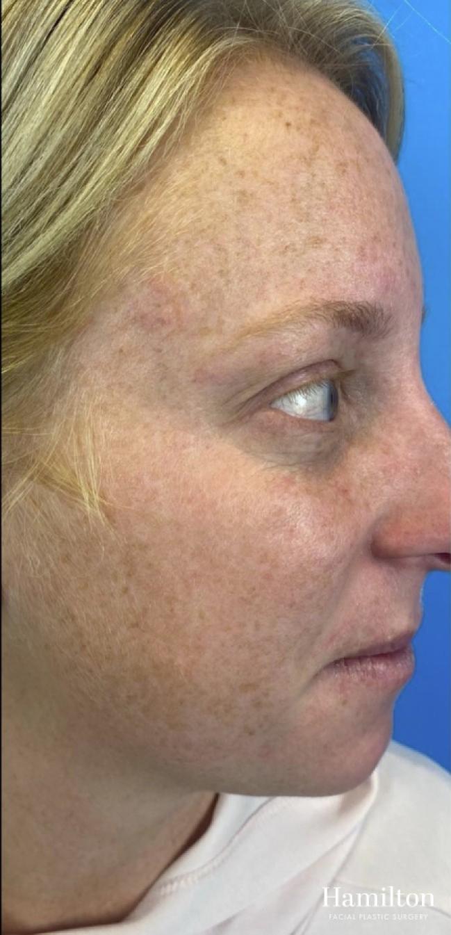 MOXI Laser: Patient 2 - Before 2