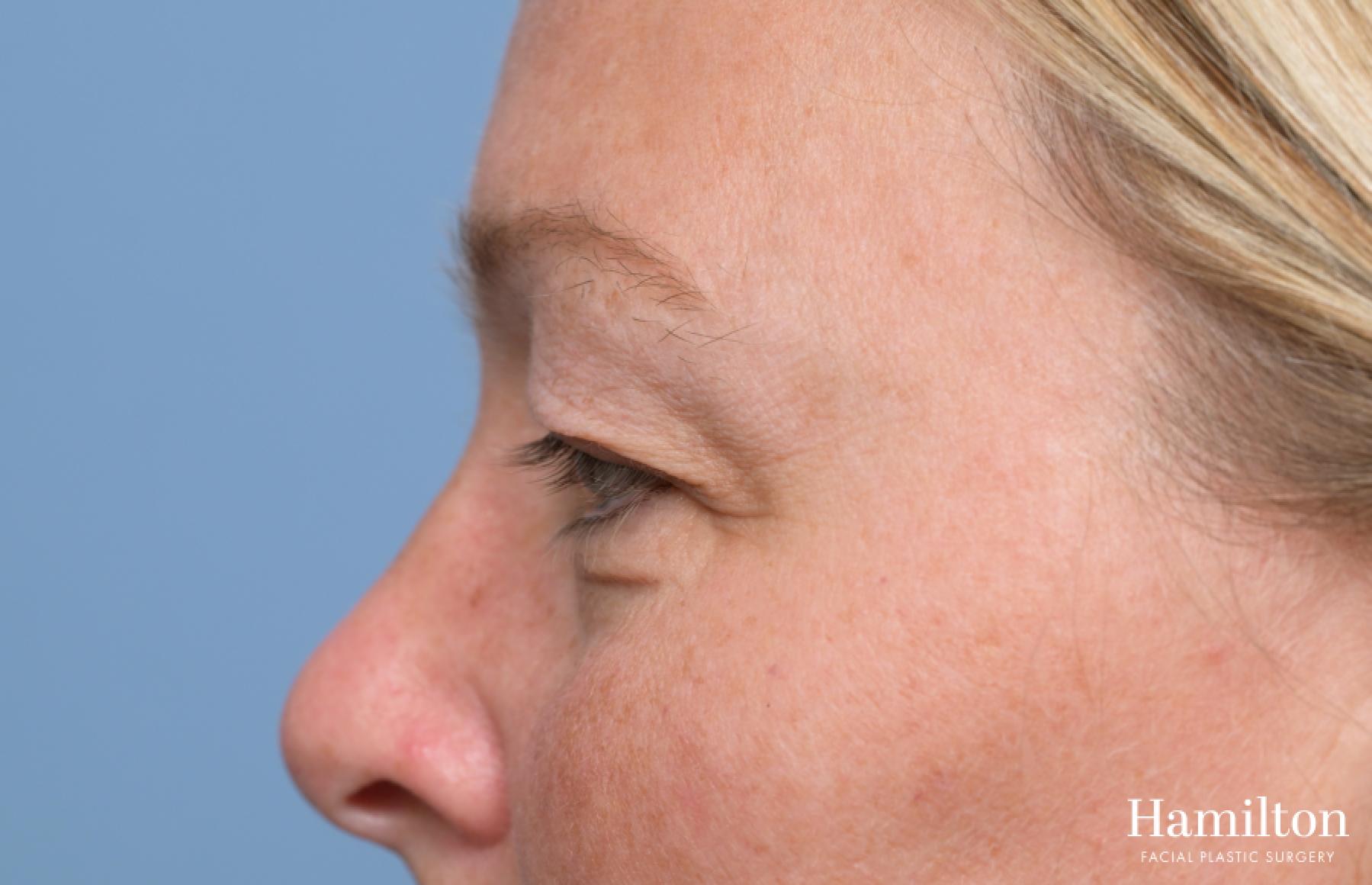 Blepharoplasty: Patient 2 - Before 4