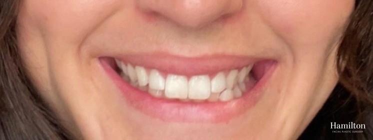 Neurotoxins/Botox: Patient 6 - After  