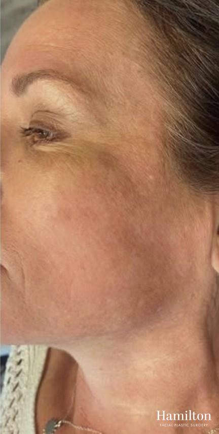 Broad Band Light (BBL): Patient 9 - After  